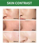 Acne Removal Mousse Facial Cleanser - Image 2